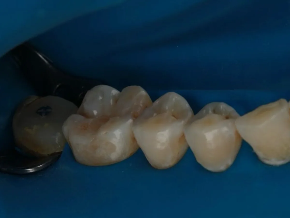 Detalhe do trabalho odontológico da Dra. Lara Eckert